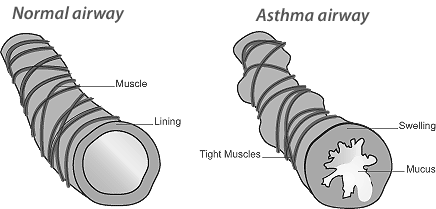 Asthma airway